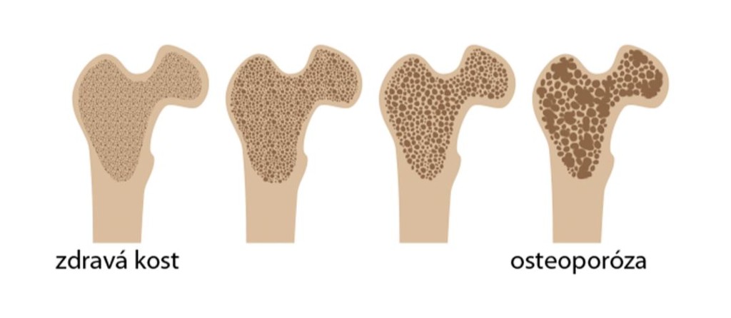 zdravá kost vs. osteoporóza